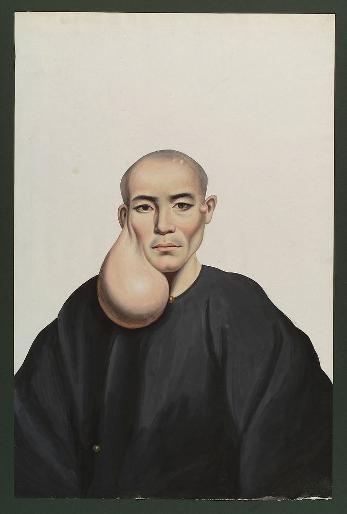 A man with a pendent tumour below his right ear. Gouache, 18--, after Lam Qua, 1830/1850.