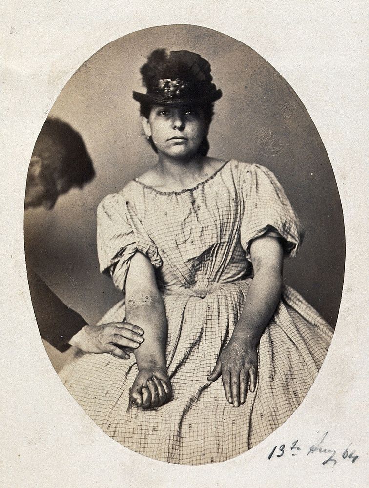 A young woman, sitting; she has a mark on the middle of her right arm. Photograph by L. Haase after H.W. Berend, 1864.