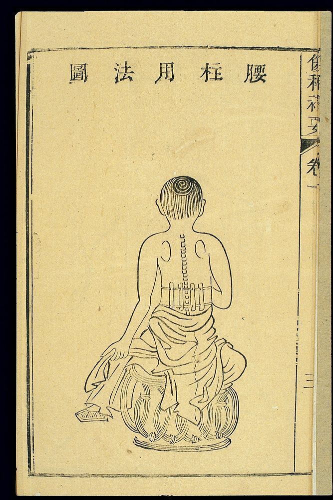 Chinese woodcut: Lumbar fixation splint