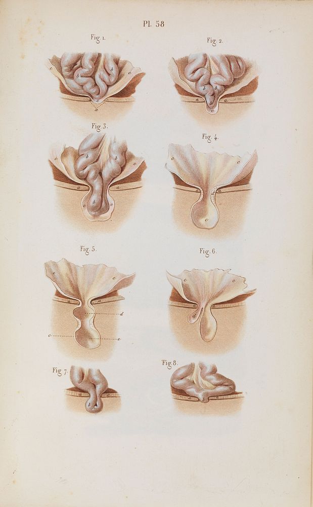 Plate 58, Illustration of the formation of hernias.