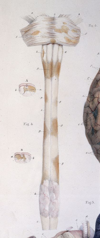 Pathological anatomy : illustrations of the elementary forms of disease / By Robert Carswell.