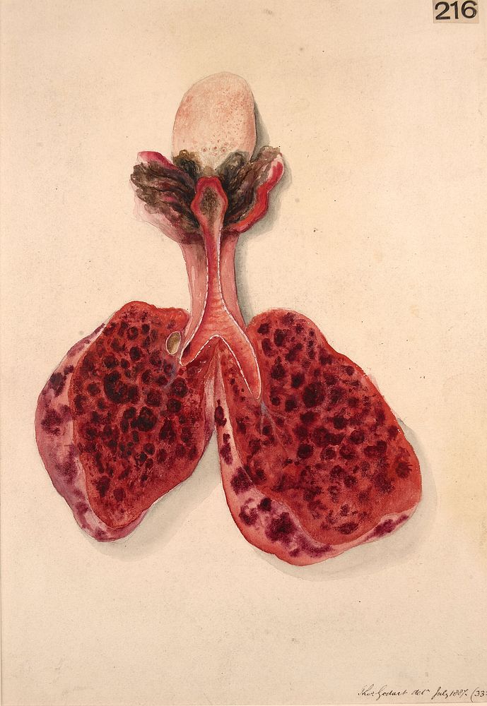 Tongue, tonsils, larynx, trachea and lungs from a case of diphtheria