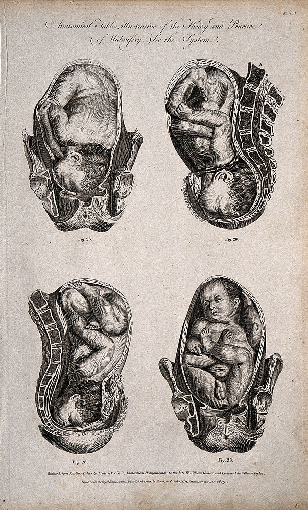 Four babies in different delivery positions in the womb. Engraving by W. Taylor, 1791, after F. Birnie after W. Smellie.