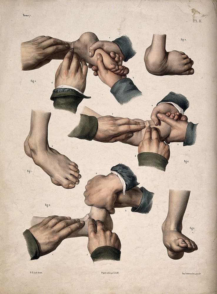 Six diagrams illustrating various clubfeet and operations demonstrating how to cure them. Coloured lithograph by J.B.F.…