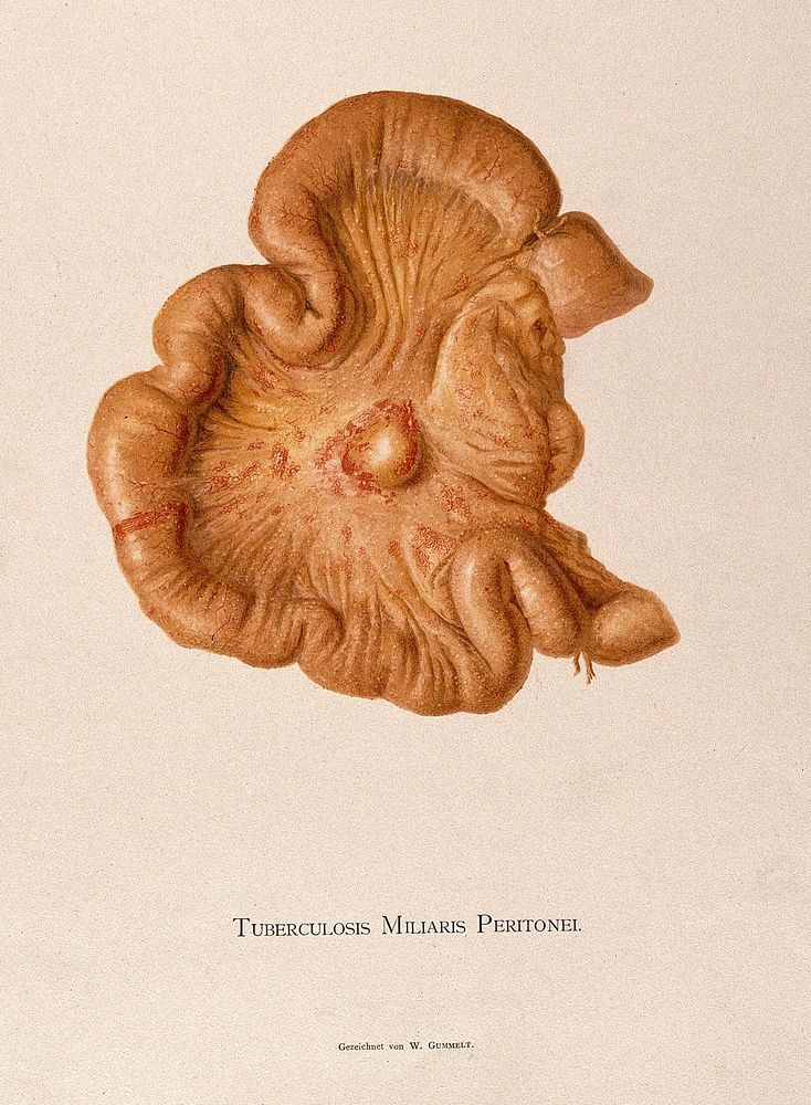 A peritoneum showing signs of tuberculosis. Chromolithograph by W. Gummelt, ca. 1897.