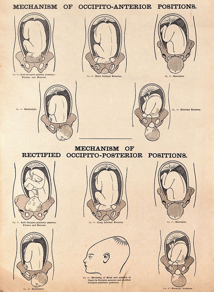 Mechanisms of occipito-anterior positions and rectified occipito-posterior positions of the foetus. Lithograph after W. F.…