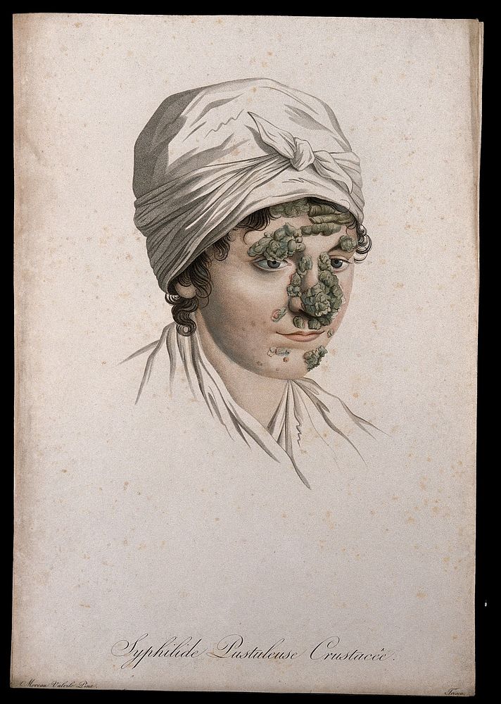 A woman with a skin disease on her face. Coloured stipple engraving by S. Tresca after Moreau-Valvile, c. 1806.