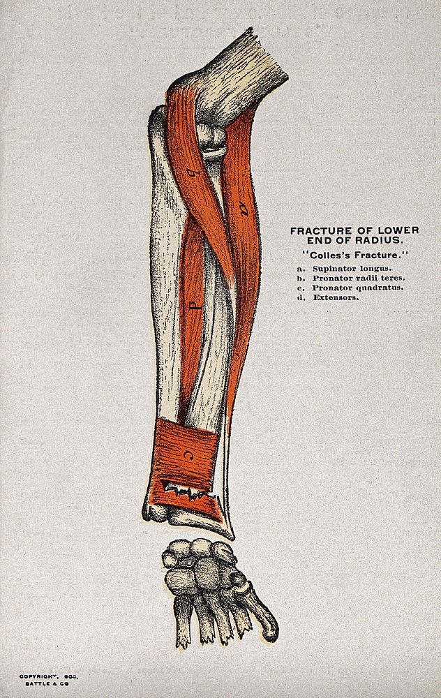 Fracture of the lower end of the radius, called "Colles's fracture". Lithograph by Battle & Co.