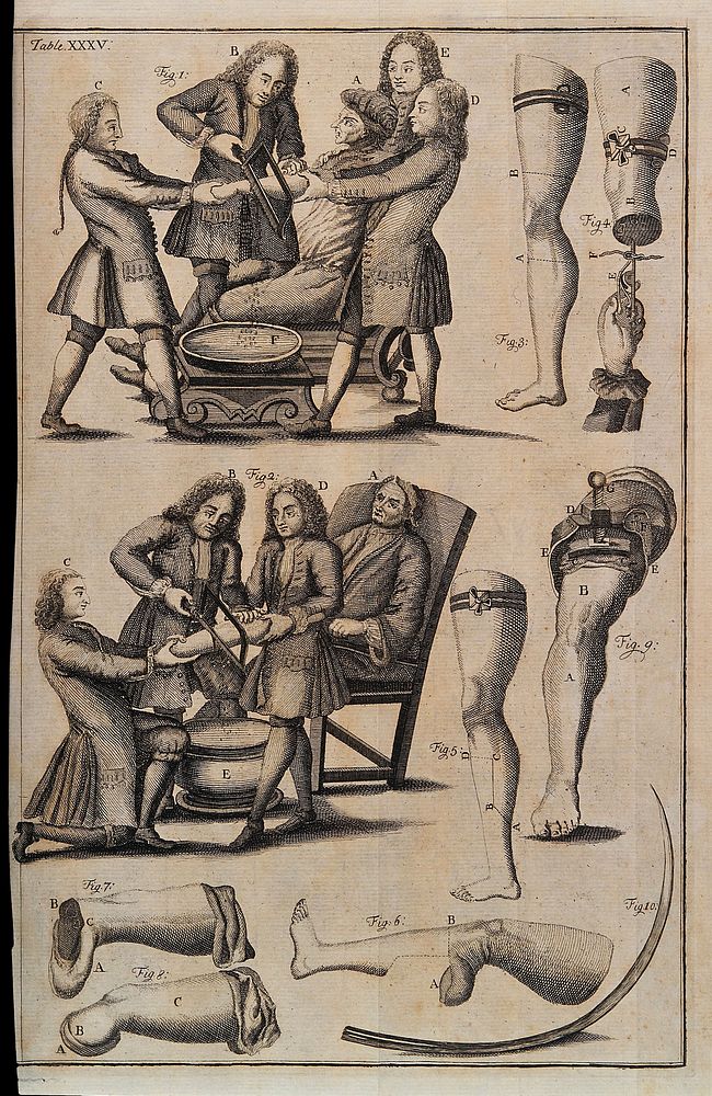 Amputations of arm and leg with diagrams to illustrate how to perform the operations. Engraving, 1743.