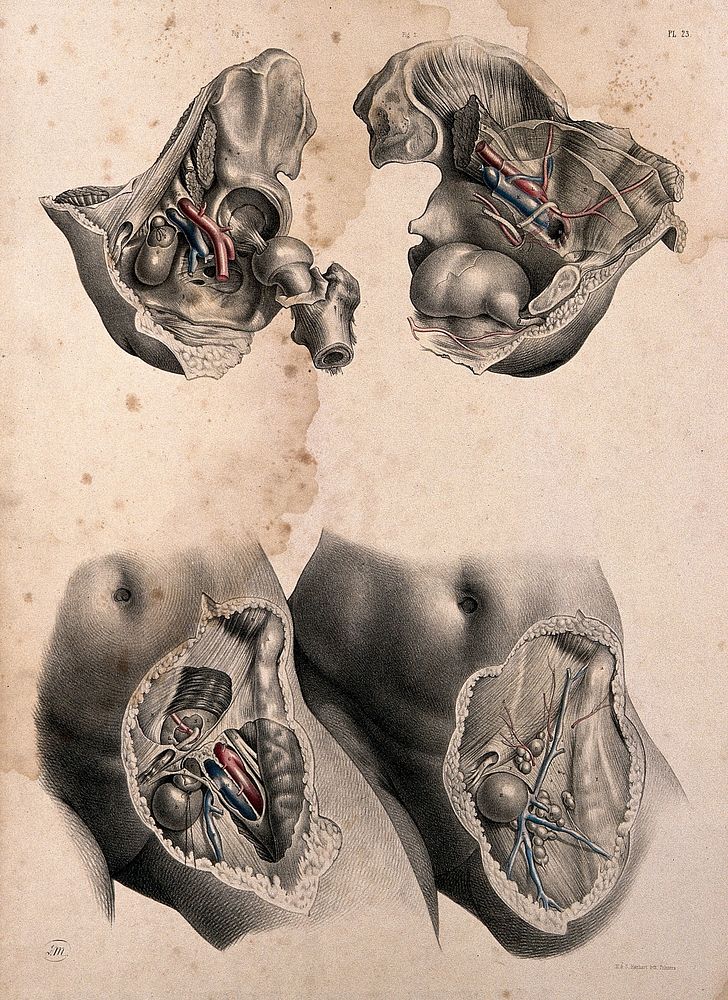 Femoral hernia: four figures. Coloured lithograph by J. Maclise, 1851.