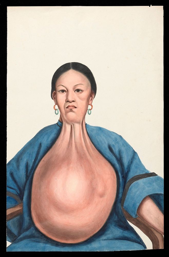 A woman (Yang She), facing front, with a massive pendent tumour hanging down from her neck. Gouache, 18--, after Lam Qua…