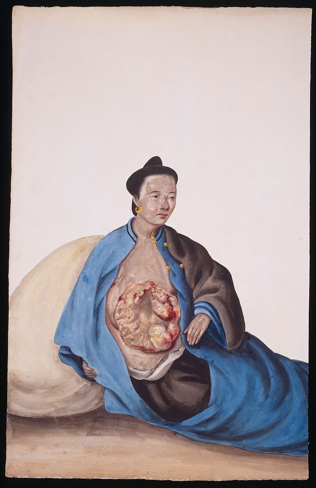 A woman with a tumour in her right breast which is expanding over her trunk. Gouache, 18--, after Lam Qua, ca. 183-.