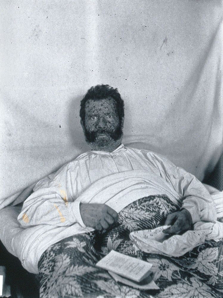Gloucester smallpox epidemic, 1896: George Allen, a smallpox patient. Photograph by H.C.F., 1896.