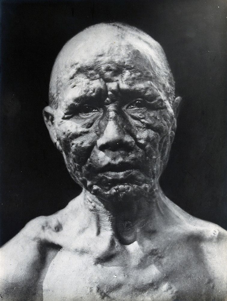 Leprosy: head and shoulders portrait of a male sufferer. Photograph, 1870/1910.