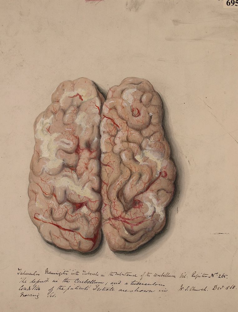 Surface of the cerebral hemispheres, from a case of tubercular meningitis