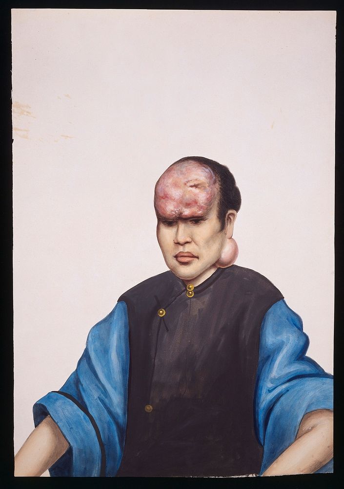 A woman (Le Sanying) with tumours on her forehead and under her left ear. Gouache, 18--, after Lam Qua, ca. 1838.