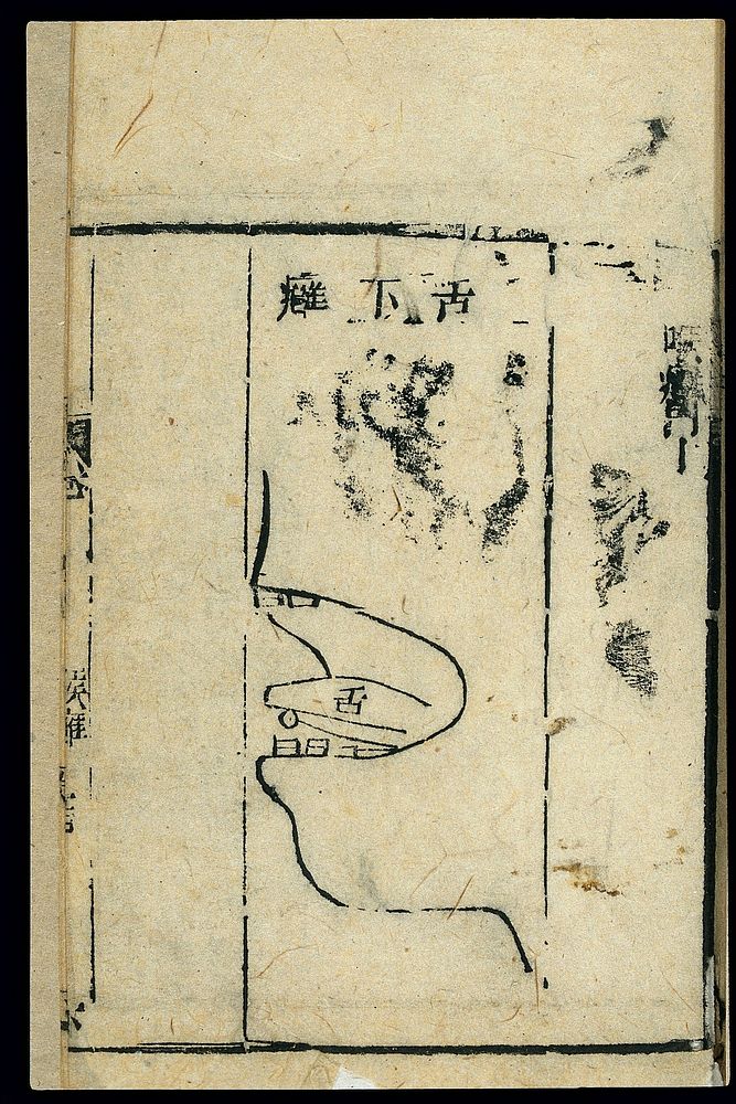 Chinese C19 woodcut: Abscesses beneath the tongue
