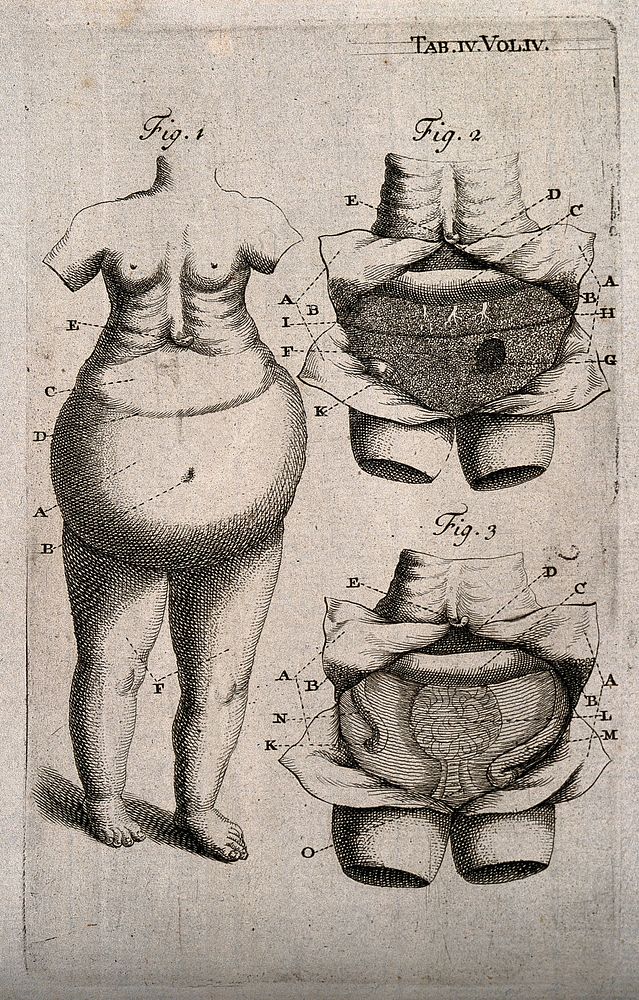 A woman with a distended stomach; with two dissected views of her abdomen. Engraving, c.1710.