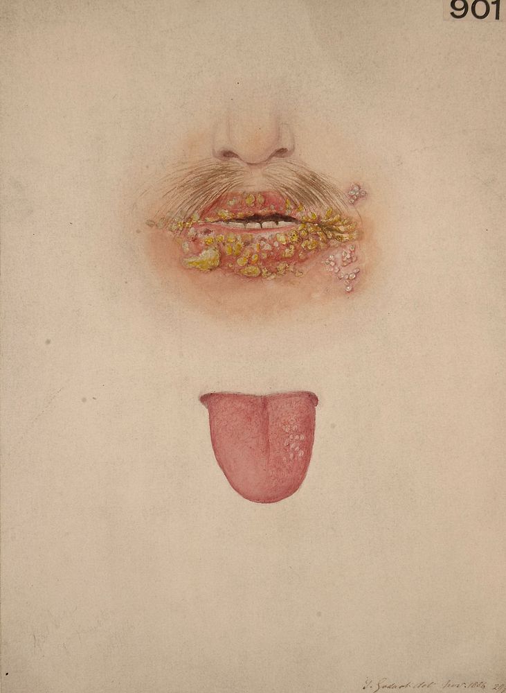 Lips and tongue of a man affected with pustular herpetic eruptions