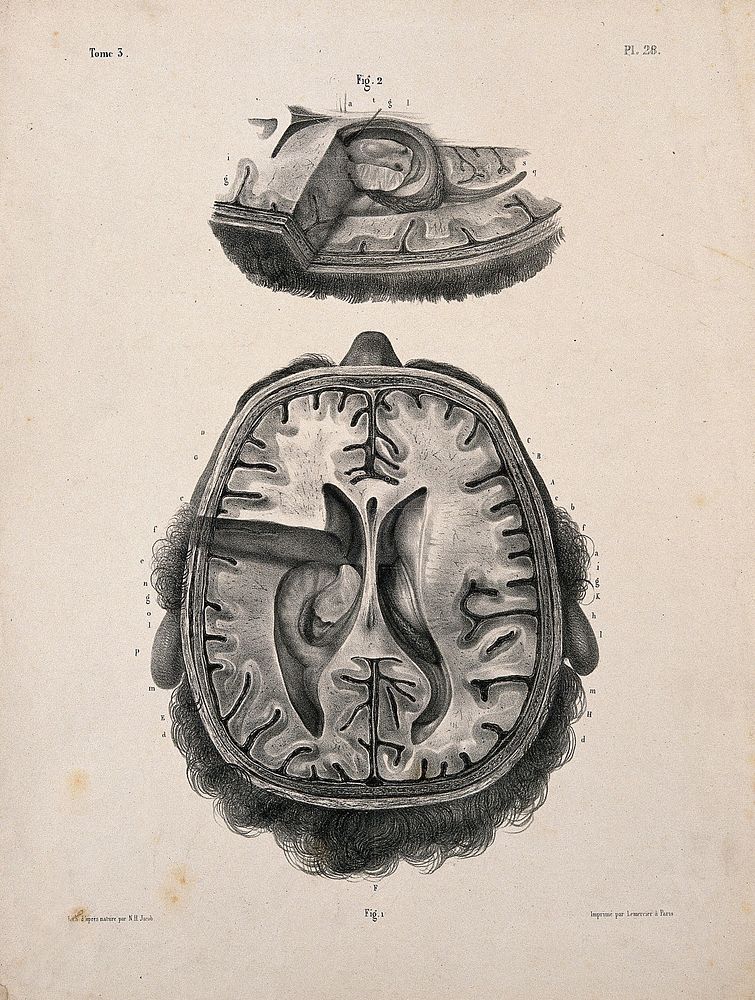 The brain: two figures of a section through a head and brain, showing the lateral ventricles and third ventricle. Lithograph…