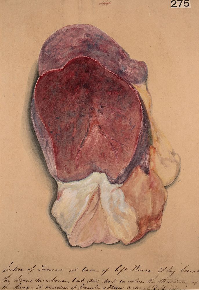 Section of tumour lying beneath the pleura at the base of the lung