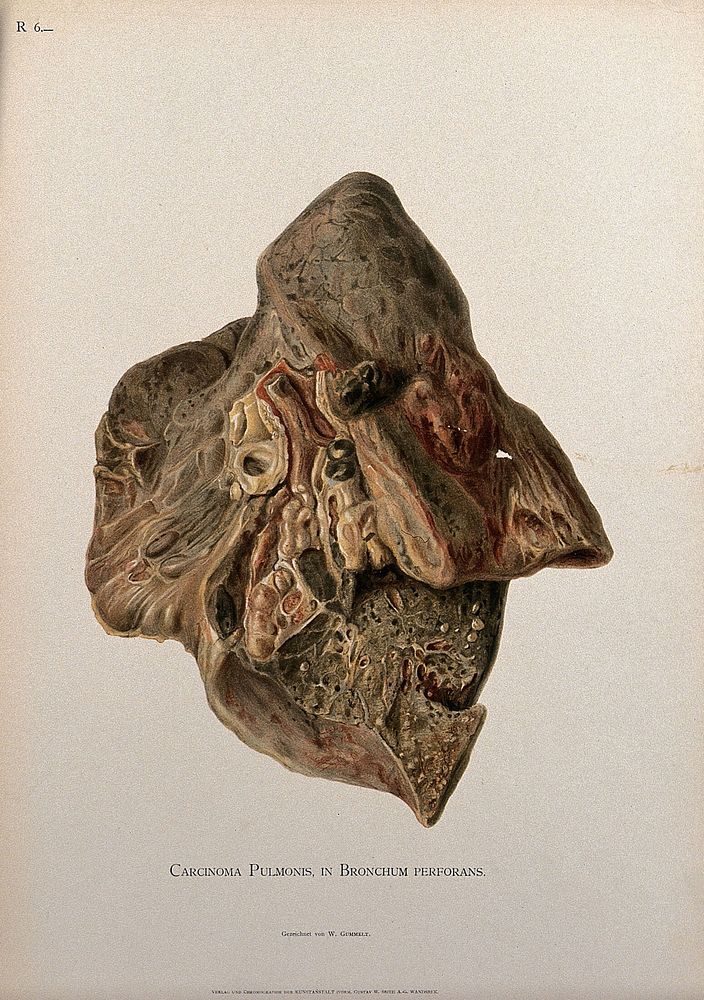 A cancerous lung and bronchi. Chromolithograph by W. Gummelt, ca. 1897.