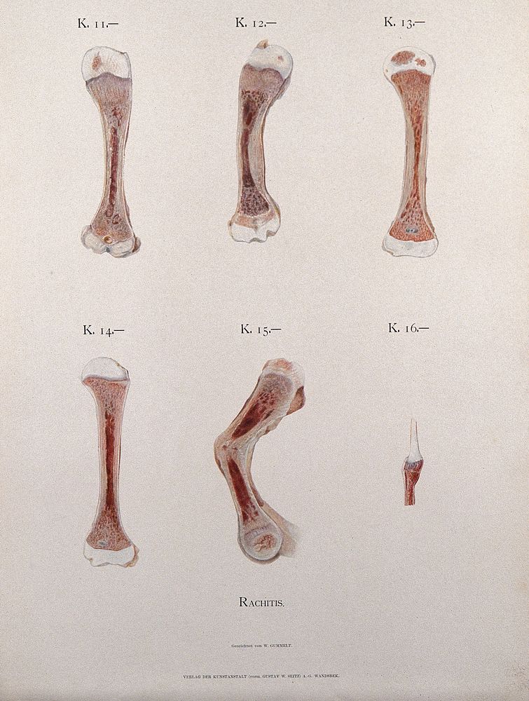 Sections through bones affected by rickets. Chromolithograph by W. Gummelt, ca. 1897.