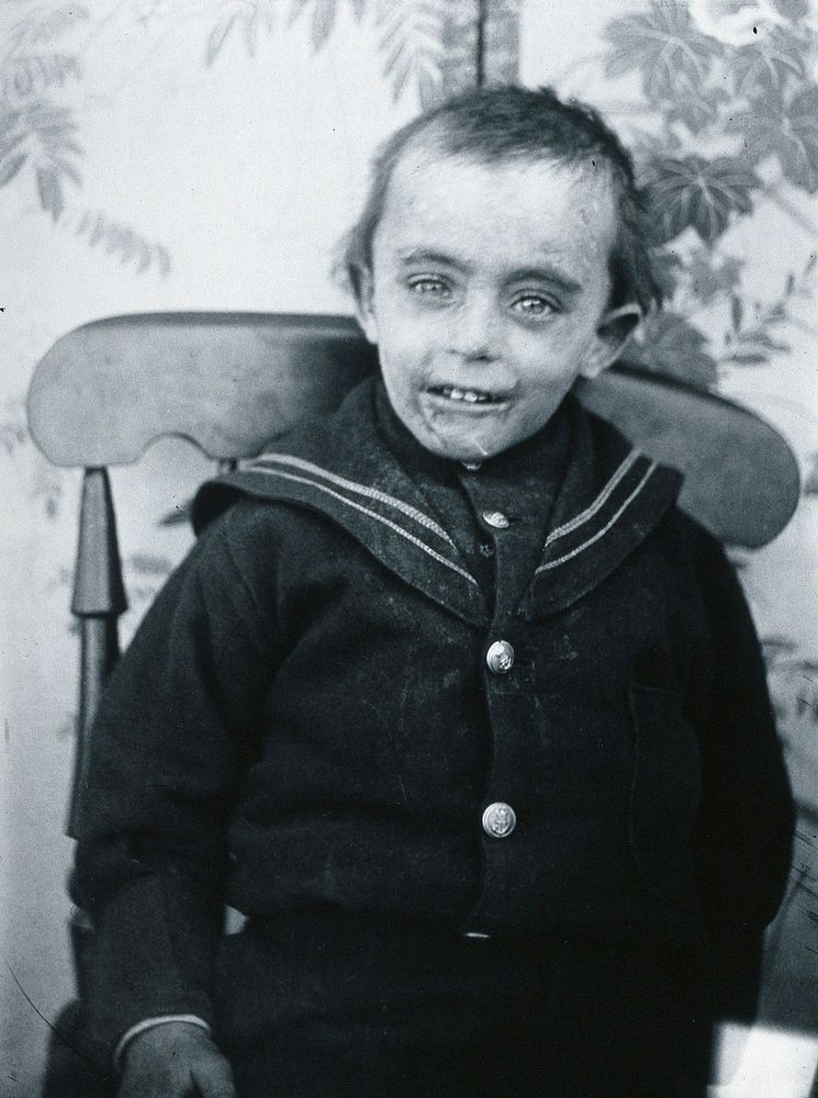 Gloucester smallpox epidemic, 1896: a boy named Matthews, a smallpox patient. Photograph by H.C.F., 1896.