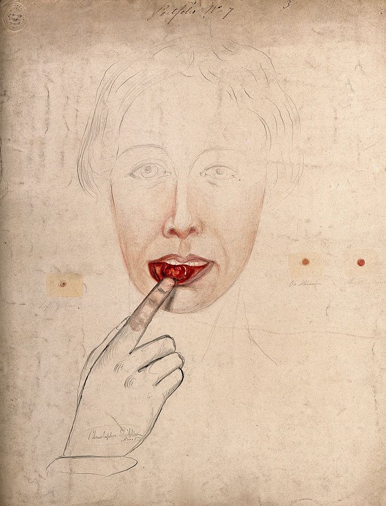 A woman pointing to a sore or abcess inside her lower lip (possibly chancre of the lip), with details showing sores found on…