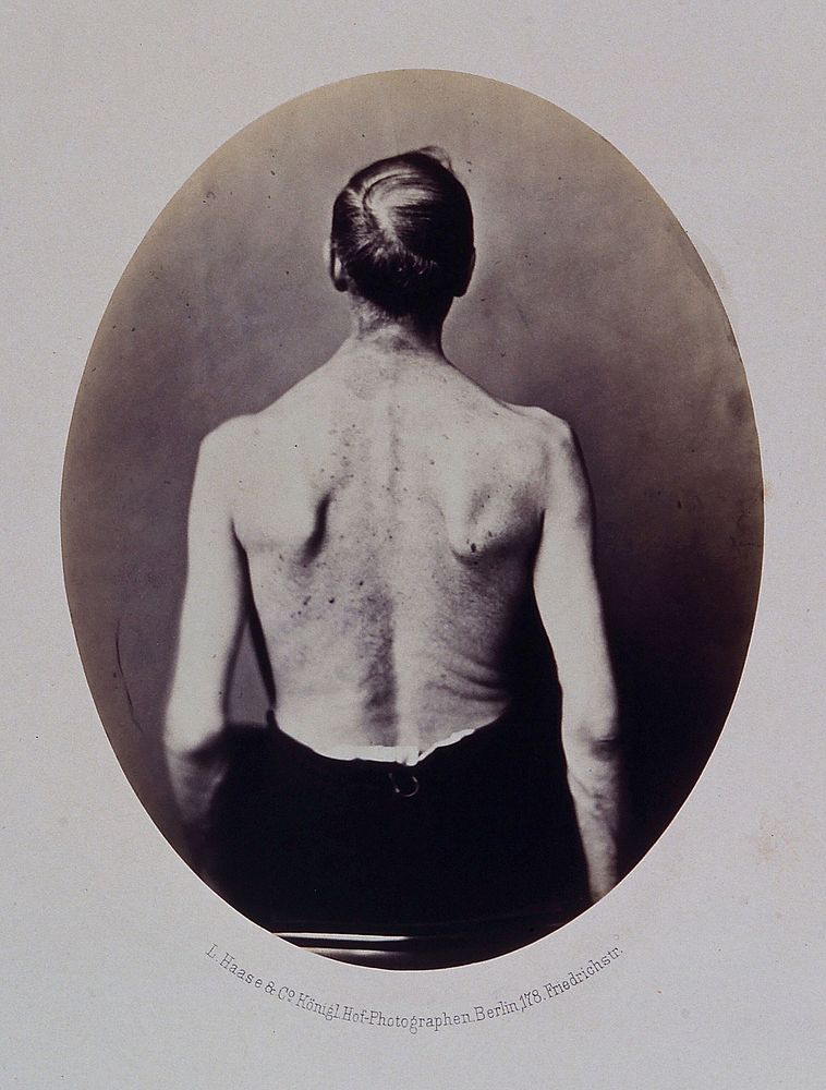 A seated man, viewed from behind, unclothed to the waist. Photograph by L. Haase after H.W. Berend, 1862.