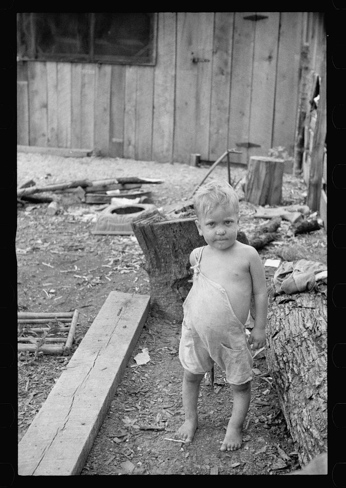 Sharecropper's child suffering from rickets and malnutrition, Wilson cotton plantation, Mississippi County, Arkansas.…