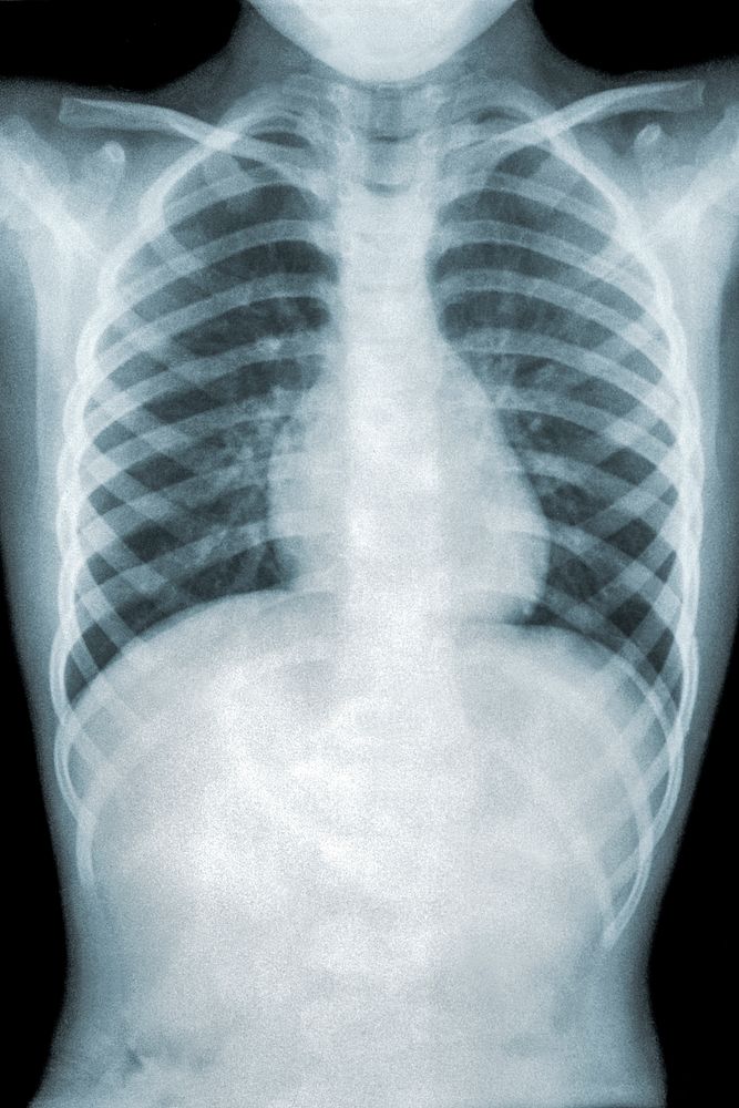Chest x-ray of a patient with mycoplasma pneumonia. Original image sourced from US Government department: Public Health…