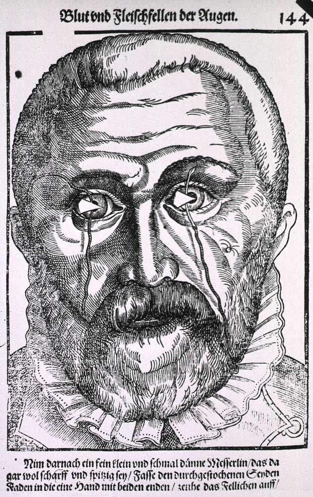 Surgical treatment of pterygiumCollection:Images from the History of Medicine (IHM) Author(s):Bartisch, George, 1535…