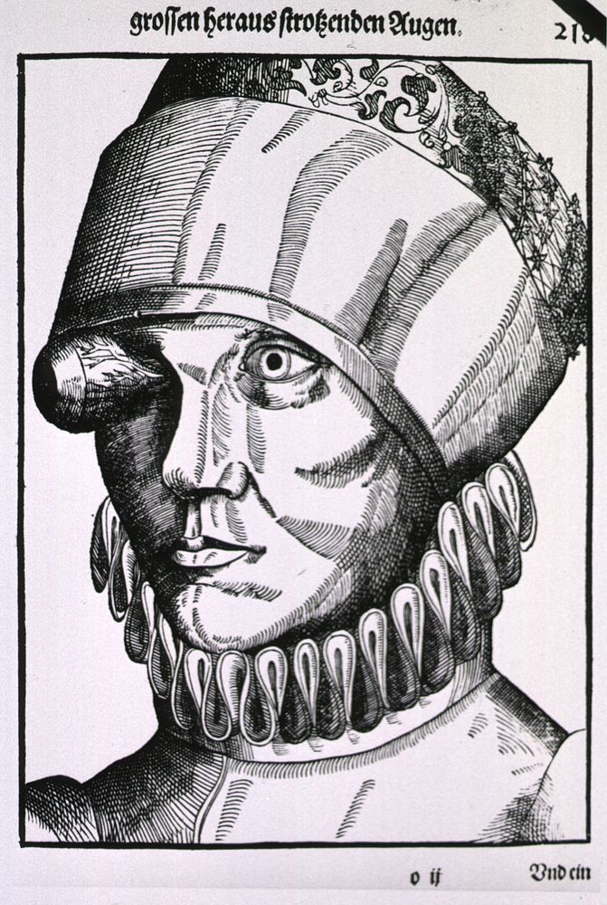 Prolapse of the IrisCollection:Images from the History of Medicine (IHM) Author(s):Bartisch, George, 1535-approximately…