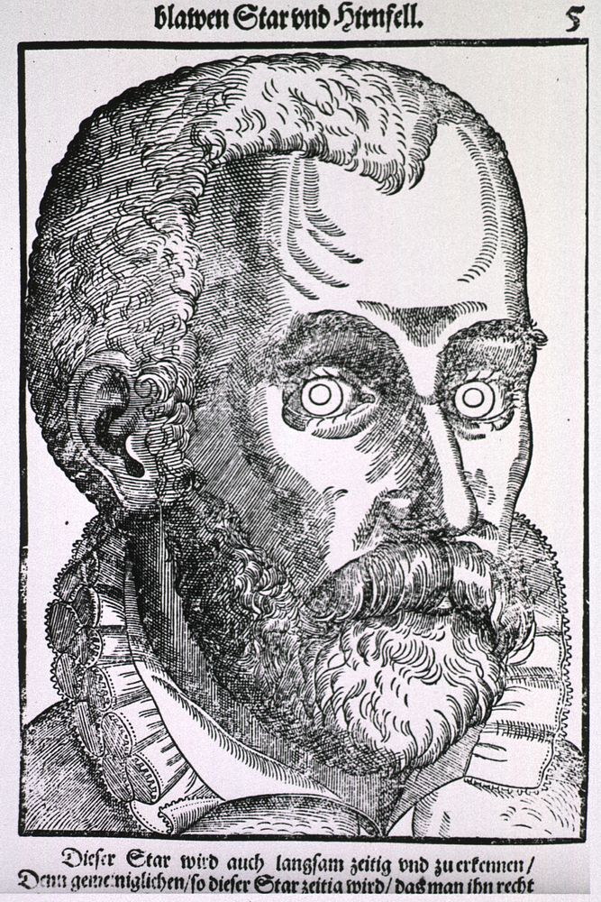 Man with Blue CataractCollection:Images from the History of Medicine (IHM) Author(s):Bartisch, George, 1535-approximately…