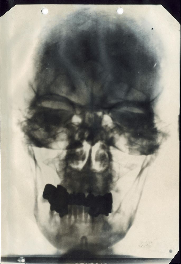 X-ray of Hitler's head.  X-ray image of Adolf Hitler's head. Hitler as seen by his doctors, between annex I and III.…