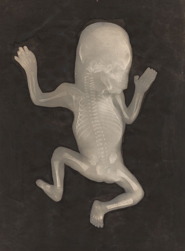 Degree of Ossification of a Five-Month-Old Fetus (Degré d'ossification d'un Foetus de cinq mois) by Unknown