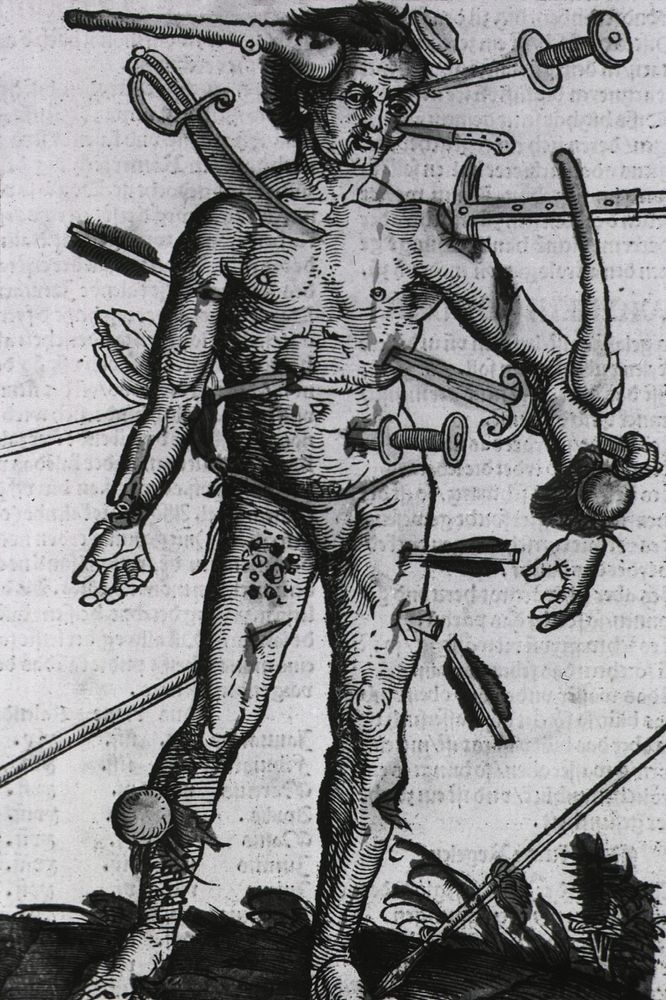 Wound Man by Gersdorff, Hans von, -1529.