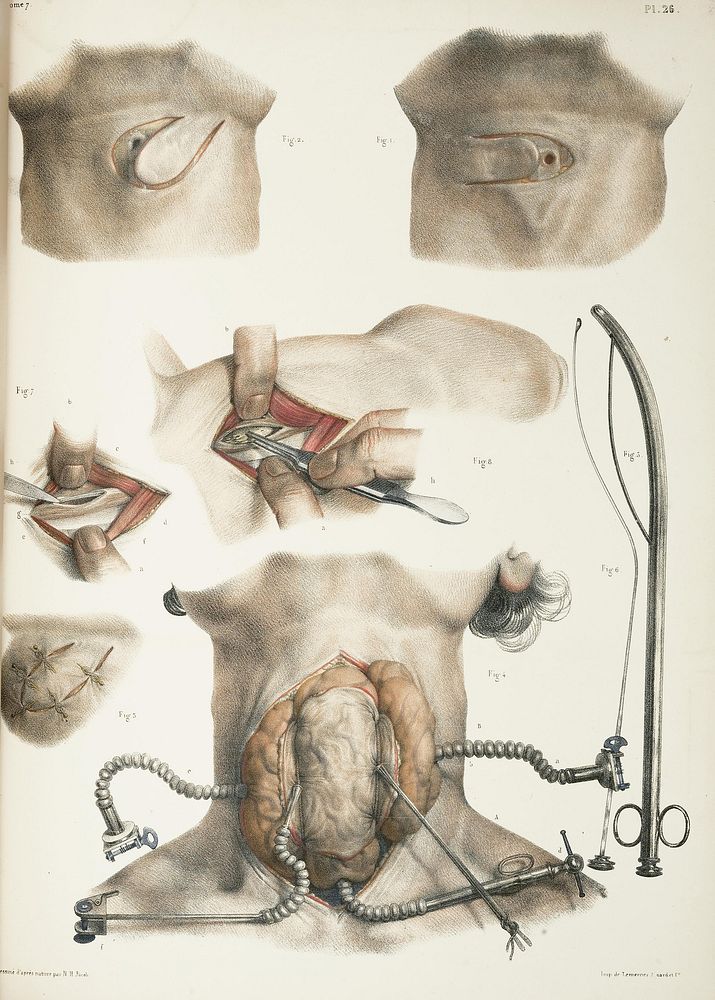Various surgical procedures of the neck. Illustrations of the surgical repair of the bronchus, the Mayor technique for…
