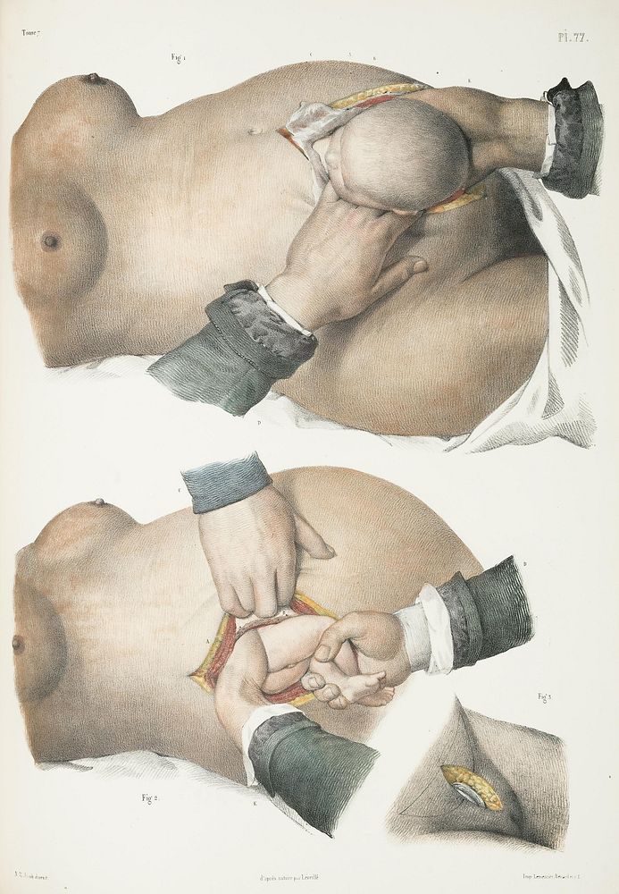 Caesarean methods. Two illustrations on a page showing three different caesarean methods. Some French text visible at…