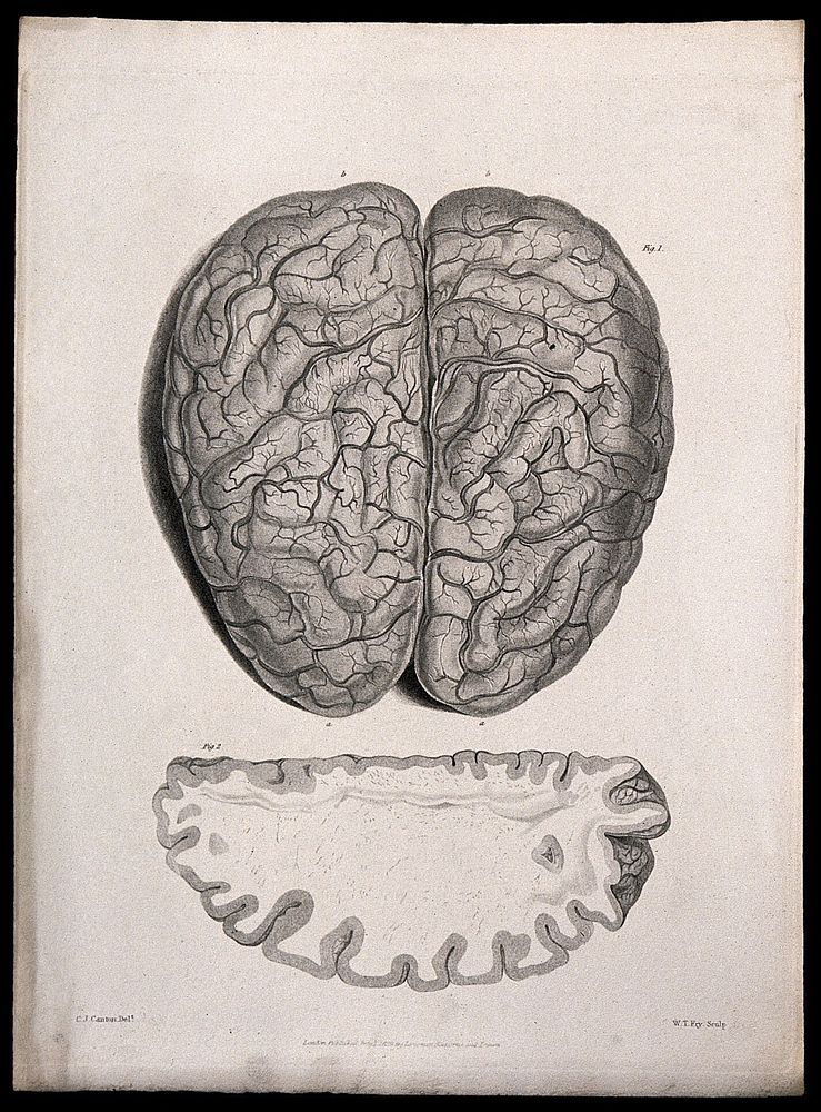 A diseased brain; and a section of diseased brain. Stipple etching by W. T. Fry after C. J. Canton for Richard Bright, 1829.
