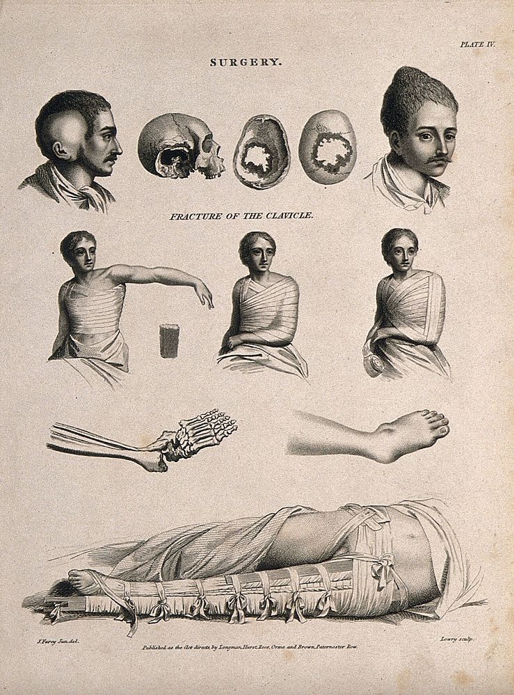 Abnormal heads and skulls, fractured and bandaged clavicle and a broken  leg bandaged in a splint. Engraving by W. Lowry…