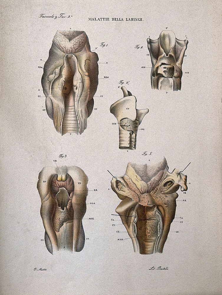 Five sections of diseased larynx, numbered for key. Coloured lithograph by Batelli after Ottavio Muzzi, c. 1843.