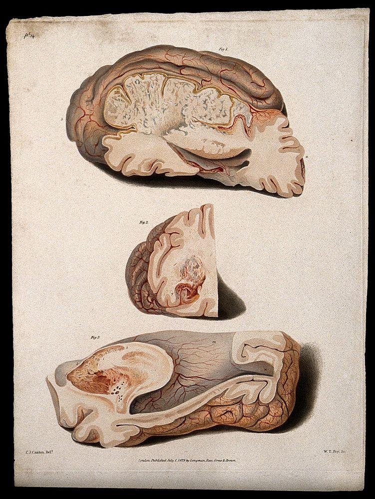 Three sections of diseased brain. Coloured stipple etching by W. T. Fry after C. J. Canton for Richard Bright, 1829.