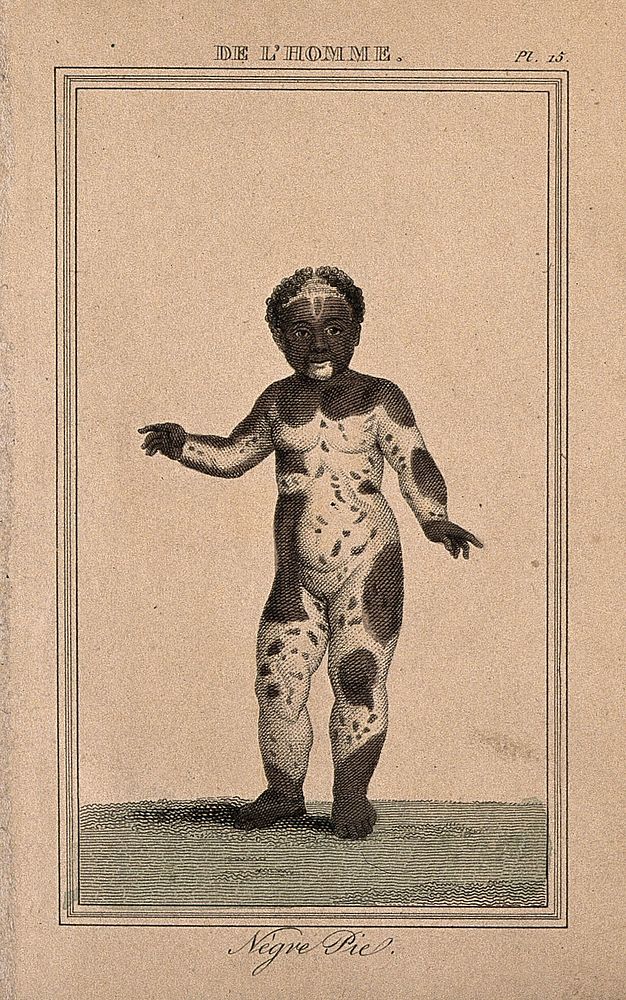 A black child displaying areas of white skin across her entire body (vitiligo). Etching with watercolour, 1818.