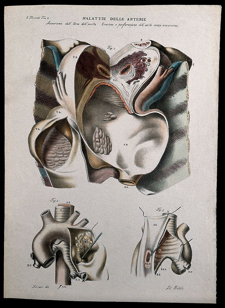 Three examples of diseased arteries of the heart, numbered for key. Coloured lithograph by Batelli after Ferdinando Ferrari…