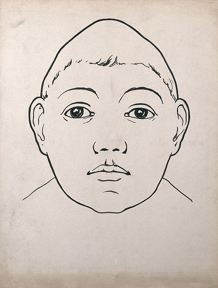 Child's head with large temporal lobes and depressed frontal lobe. Drawing, c. 1900.