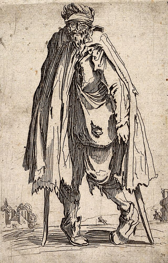 A bearded beggar with a misshapen left leg standing with two crutches. Etching possibly after J. Callot.