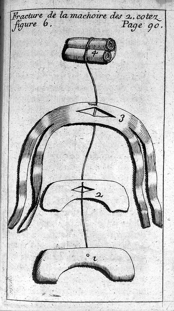 Fracture de la machoire des Z. Cotez, from Le Clerc, L'appareil commode en faveur des jeunes chirurgiens, 1700