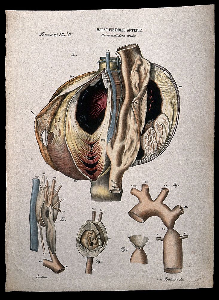 Several sections of diseased artery (aneurism of the aorta), numbered for key. Coloured lithograph by Batelli after Ottavio…